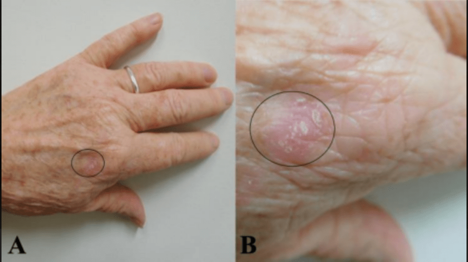  Distant (a) and closer (b) views of a red scaly plaque (black oval) on the left dorsal hand. Skin&nbsp; biopsy established a diagnosis of lichen simplex chronicus, which completely resolved within&nbsp; four weeks after starting twice-daily topical treatment with 20% cannabinoid oil. 