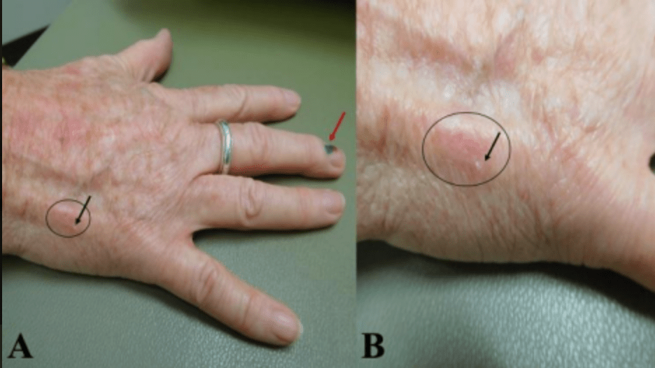 Distant (a) and closer (b) views of an erythematous patch (black oval) with a small &nbsp;focus of scale (black arrow) on the lateral right dorsal hand representing the treated &nbsp;site of a biopsy-confirmed squamous cell carcinoma that completely resolved with &nbsp;twice daily application of CBD oil for four weeks. 